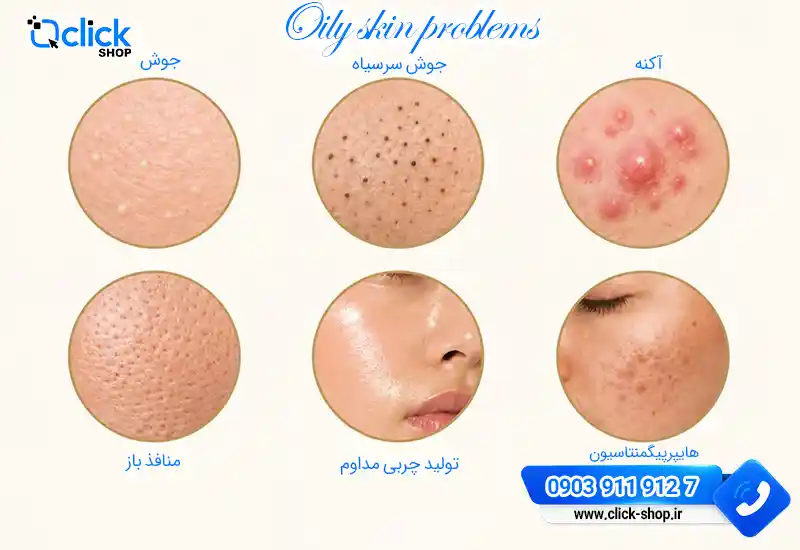 مشکلات پوست چرب